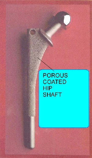 Porocoat_hip